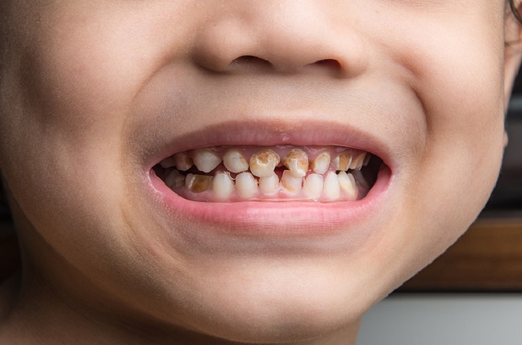 Informasi terkait penyebab kerusakan gigi pada anak, Sumber: halodoc.com