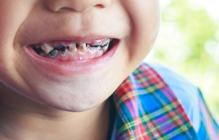 Karies yang merusak gigi anak, Sumber: kumparan.com