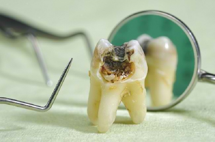 Terdapat berbagai cara untuk mencegah karies gigi, Sumber: alodokter.com