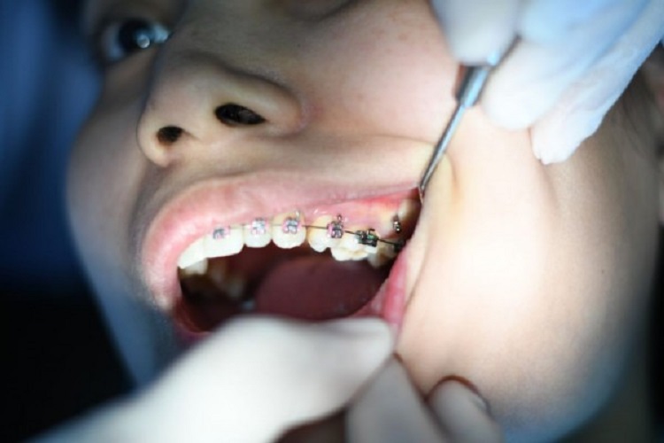 Ilustrasi pemeriksaan karang gigi setelah penggunaan behel, Sumber: idntimes.com