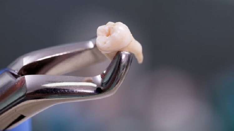 Informasi terkait apakah gigi geraham bungsu harus dicabut, Sumber: suara.com