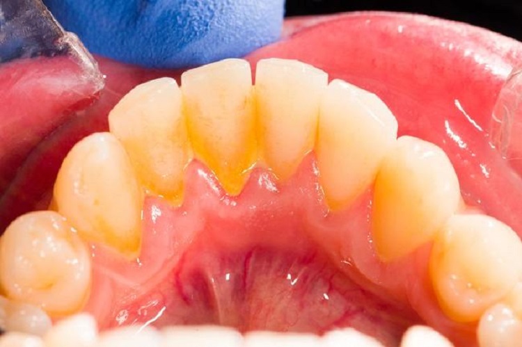 Ilustrasi karang gigi yang menumpuk pada gigi, Sumber: alodokter.com