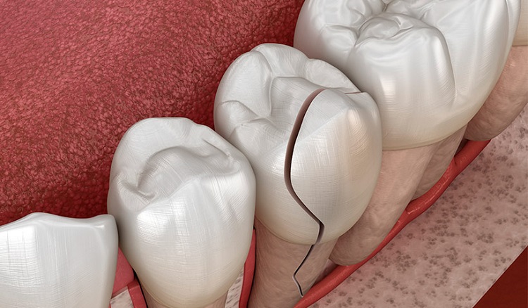 Informasi mengenai gigi geraham yang pecah, Sumber: dentistadonostia.es