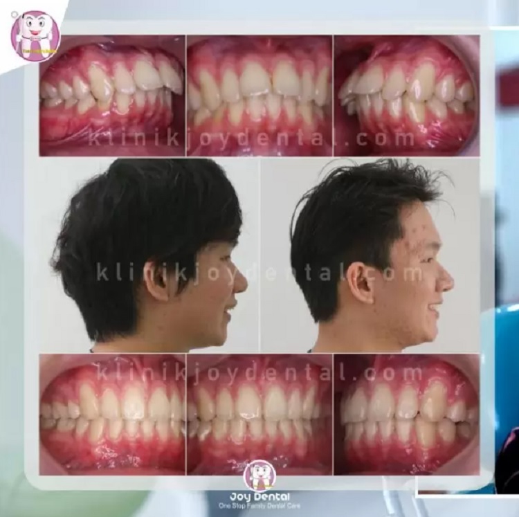 Perawatan gigi tonggos di Klinik Joy Dental, Sumber: doc pribadi
