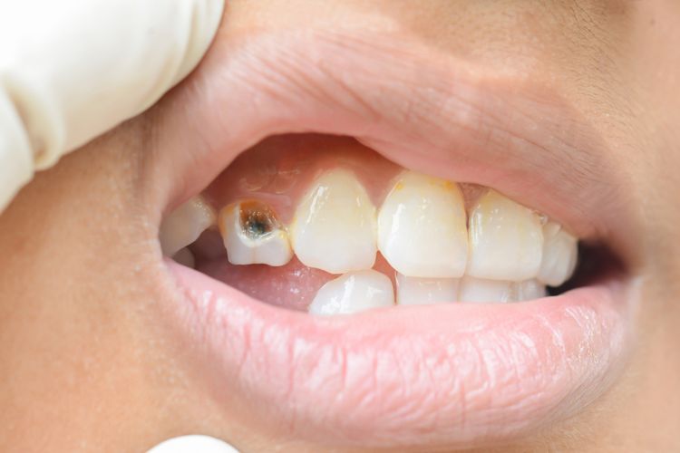 Waspadai akibat gigi berlubang yang tidak segera ditangani, Sumber: health.kompas.com