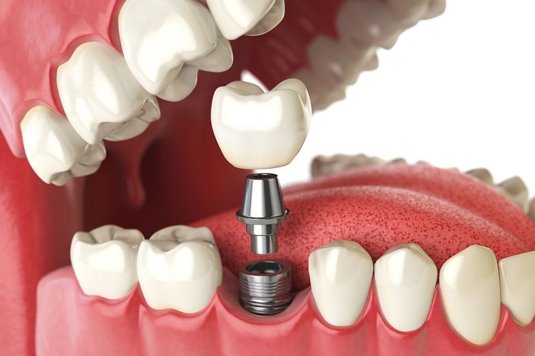 Informasi terkait bahaya pemasangan implan gigi jika dipasang tidak sesuai prosedur, Sumber: dentaltrendz.in
