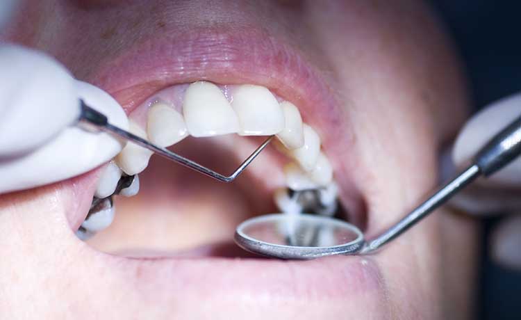 Memeriksakan kondisi gigi berlubang di dokter gigi, Sumber: absolutedental.com