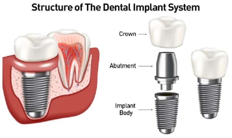 Sistem implan gigi, Sumber: fda.gov