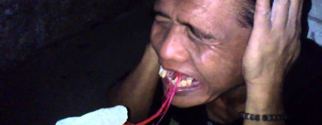 Rasa Takut Saat Dicabut Gigi