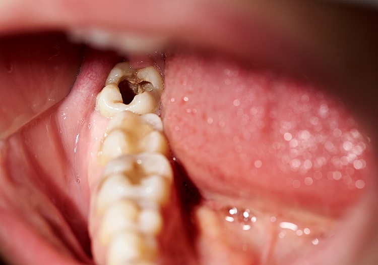 Ilustrasi gigi yang berlubang, Sumber: ciputrahospital.com