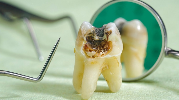 Informasi terkait ciri-ciri gigi yang mati, Sumber: klikdokter.com