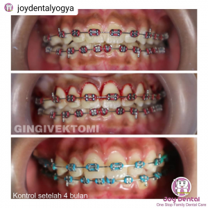 Hasil Perawatan Gingivektomi Joy Dental