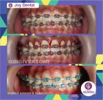 Hasil perawatan behel gigi pada kasus gummy smile