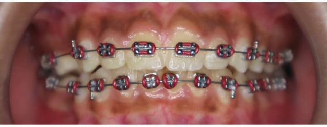 Kauter : Perawatan untuk kamu yang Gummy smile