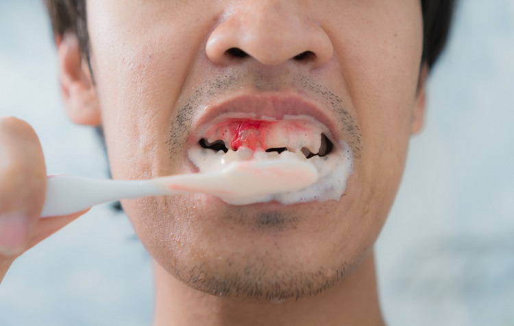 Menyikat gigi yang terlalu keras dapat melukai gusi, Sumber: dentalartssandiego.com