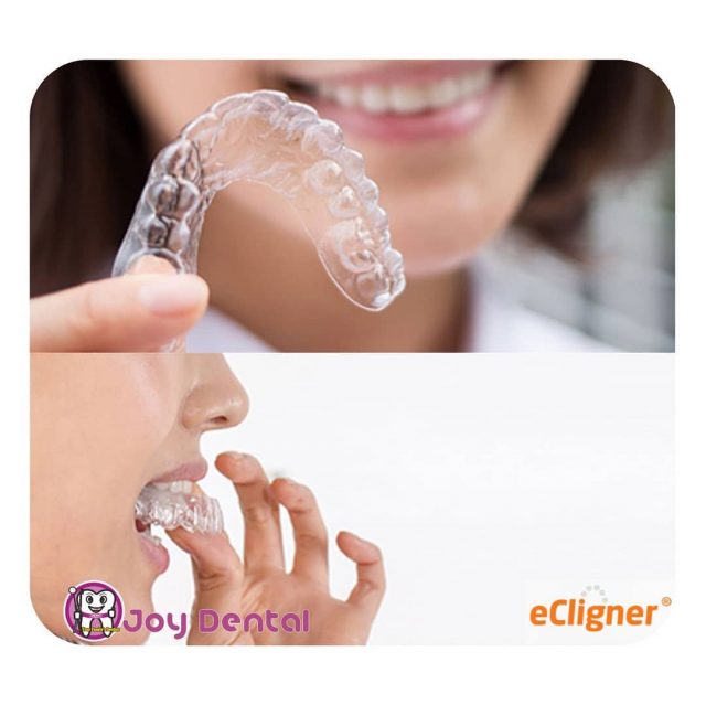 Clear aligners untuk merapikan gigi