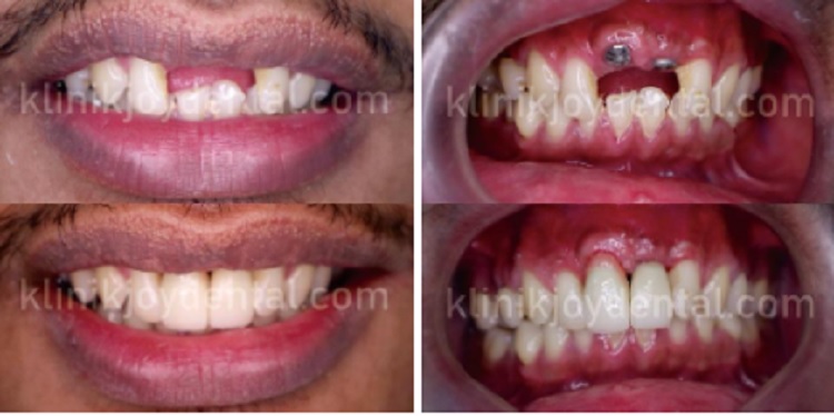 Foto dokumentasi perawatan Implan Gigi di Klinik Gigi Joy Dental, Sumber: doc pribadi