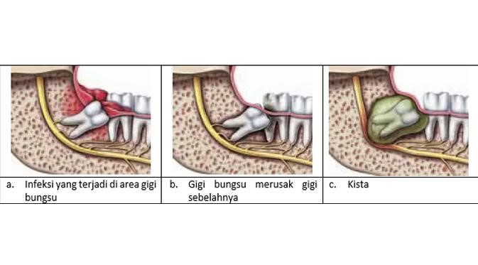 masalah gigi bungsu dalam rongga mulut
