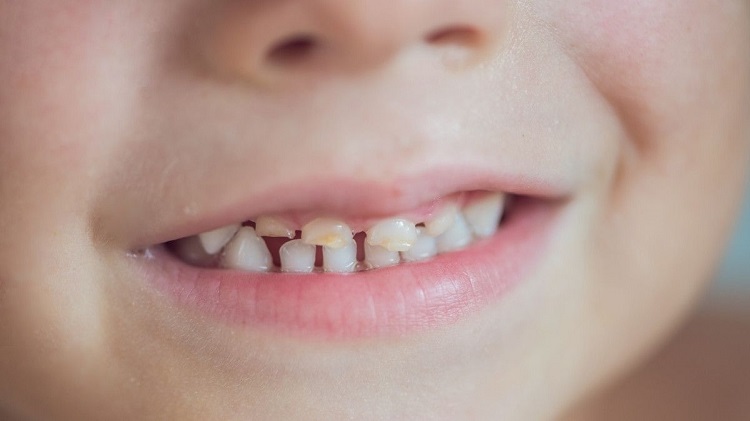Informasi terkait gigi tumpang tindih pada anak, Sumber: klikdokter.com