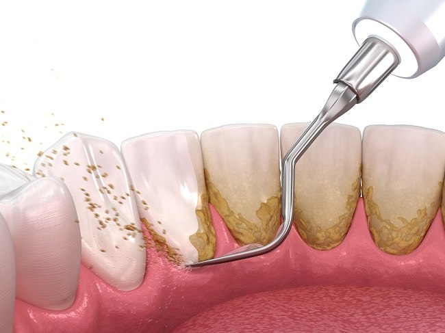 Informasi terkait manfaat membersihkan karang gigi, Sumber: alodokter.com