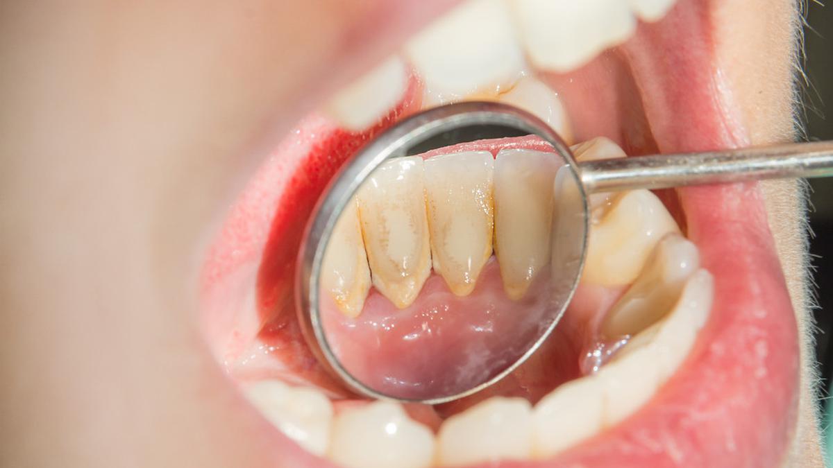 Karang gigi yang menumpuk perlu dibersihkan, Sumber: liputan6.com