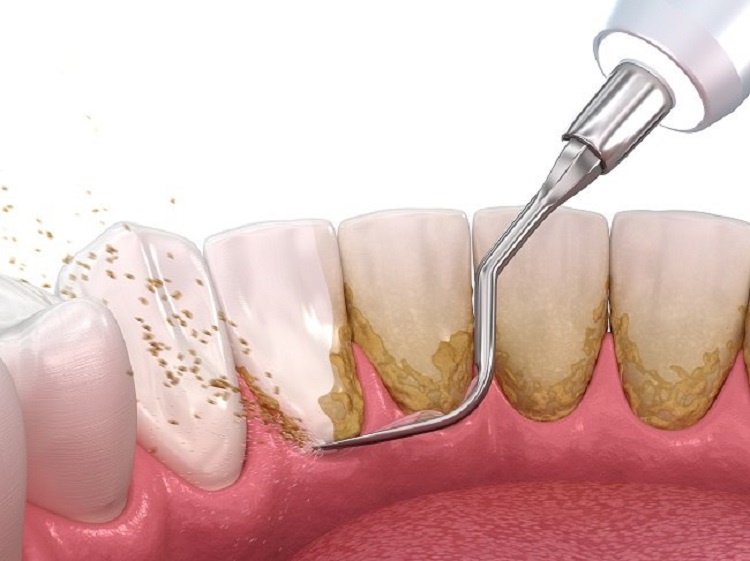Scaling dapat menghilangkan bau mulut akibat penumpukan karang gigi, Sumber: alodokter.com