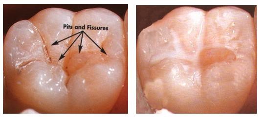 Fissure Sealant untuk Mencegah Gigi Berlubang