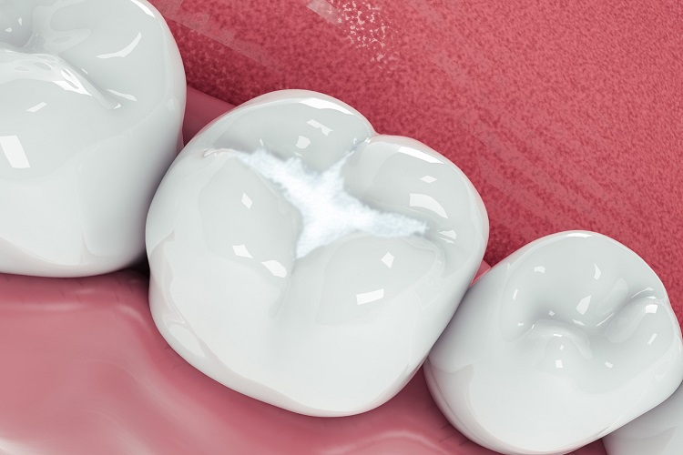Melindungi gigi dari karies dengan fissure sealant, Sumber: moirawongorthodontics.co.uk