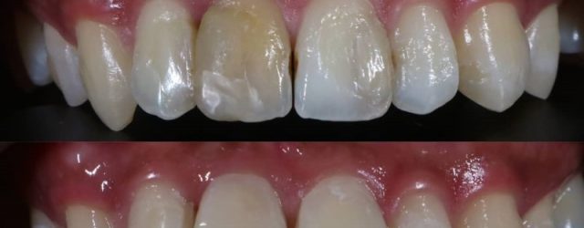 Veneer Gigi