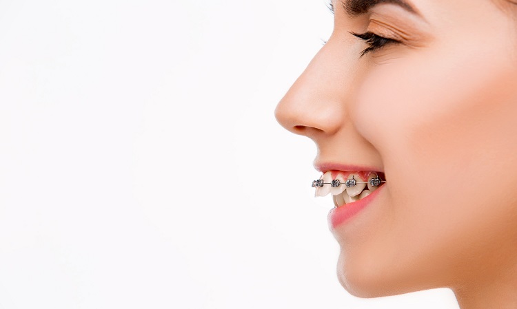 Perawatan behel dapat mengatasi gigi tonggos, Sumber: wibowodental.com