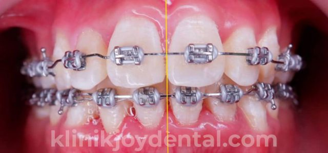 behel konvensional logam di Joy Dental