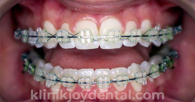 behel konvensional Transparan di Joy Dental