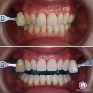 Bleaching Gigi di Klinik Gigi Joy Dental