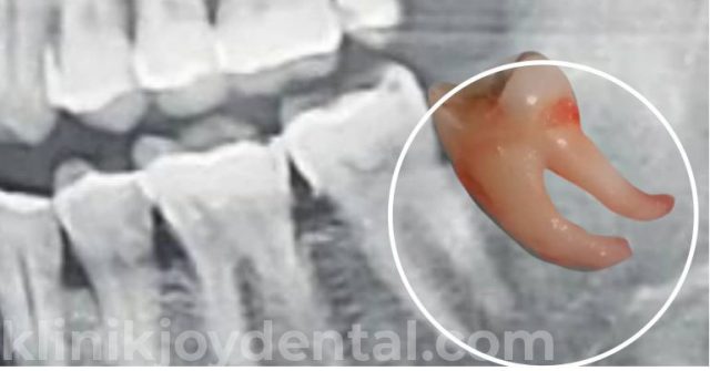 Cabut Gigi di Klinik Gigi Joy Dental