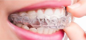 invisible aligner joy dental
