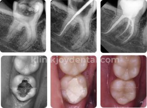 perawatan saluran akar gigi joy dental