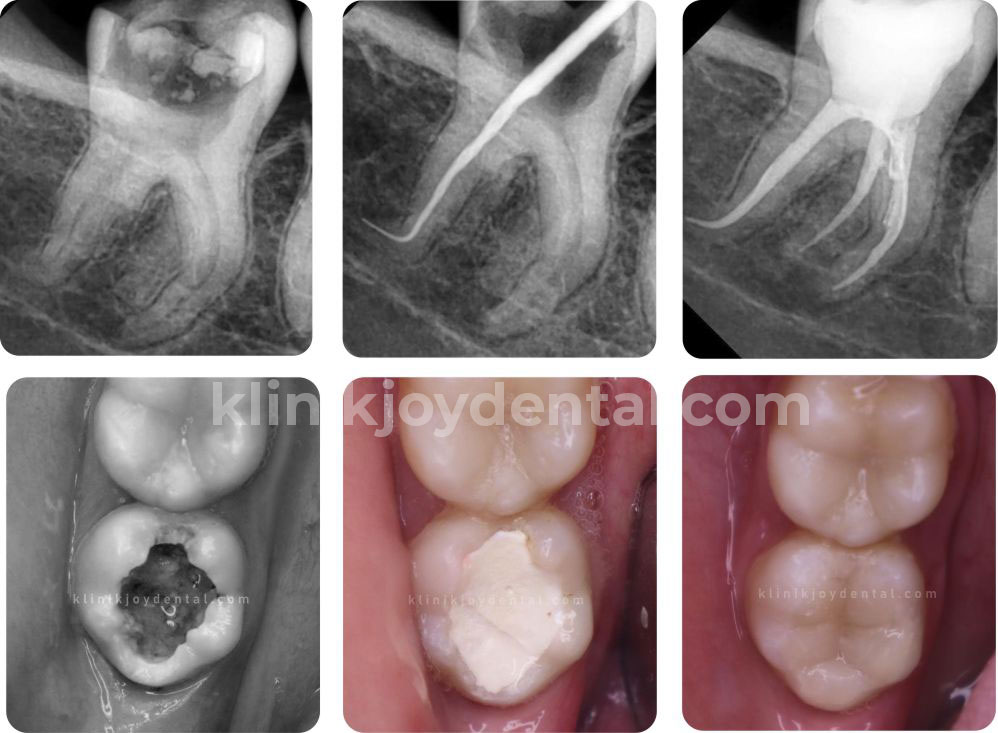 Perawatan Saluran Akar Gigi di Klinik Gigi Joy Dental