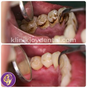 scaling / pembersihan karang gigi joy dental