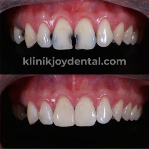 Tambal Gigi Di Klinik Gigi Joy Dental Klinik Gigi Joy Dental Yogyakarta