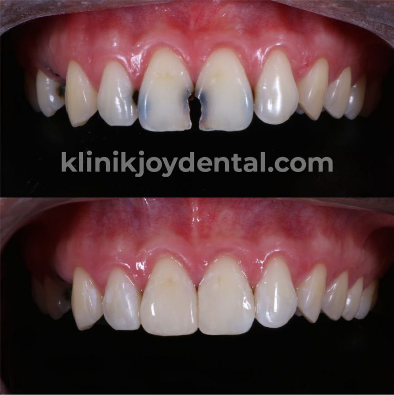 Gigi Patah dan Dentin Gigi Terbuka | Joy Dental