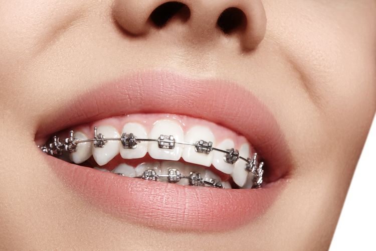 Mengenal berbagai jenis behel metal, Sumber: health.kompas.com