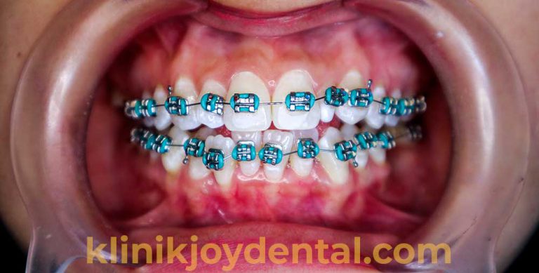 Behel Metal, Behel Murah tetapi Tidak Murahan