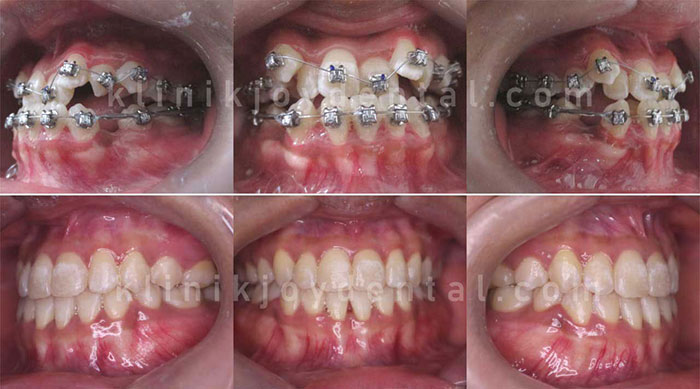 Hasil Pemasangan Behel di Klinik Joy Dental