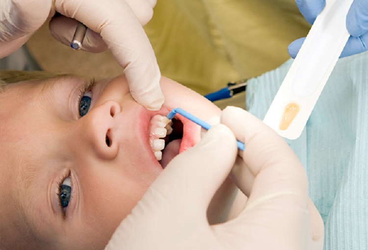 Ilustrasi pengaplikasian topical fluoride untuk gigi anak, Sumber: dentalstore.com
