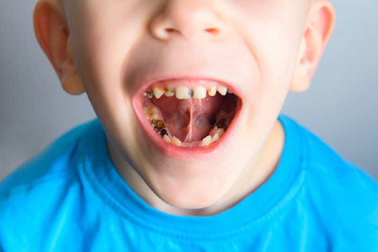 Karies gigi pada anak, Sumber: idntimes.com