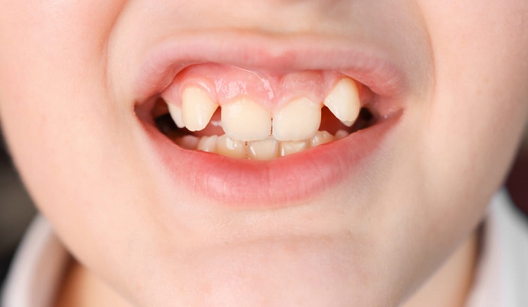 Faktor genetik juga berpengaruh terhadap kerapian gigi, Sumber: thurmanortho.com