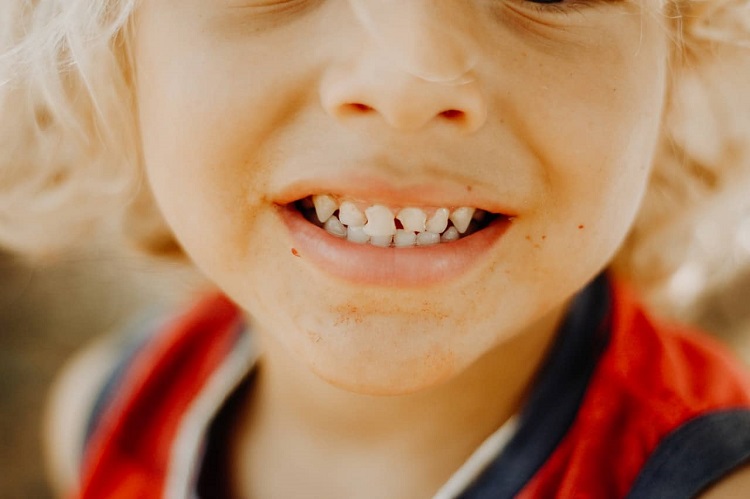 Terlambat mencabut gigi susu dapat menyebabkan gigi berantakan, Sumber: smilebar.com.au