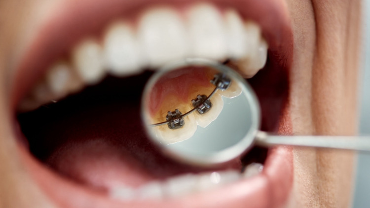 Pemasangan kawat gigi lingual hanya bisa dilakukan oleh dokter gigi spesialis ortodonsia profesional, Sumber: klikdokter.com