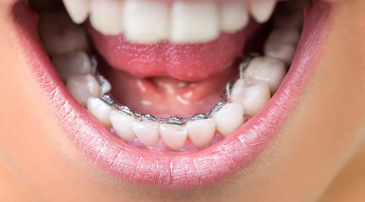 Perawatan behel gigi lingual, Sumber: duitpintar.com