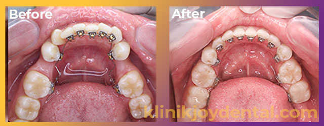 lingual braces before after joy dental